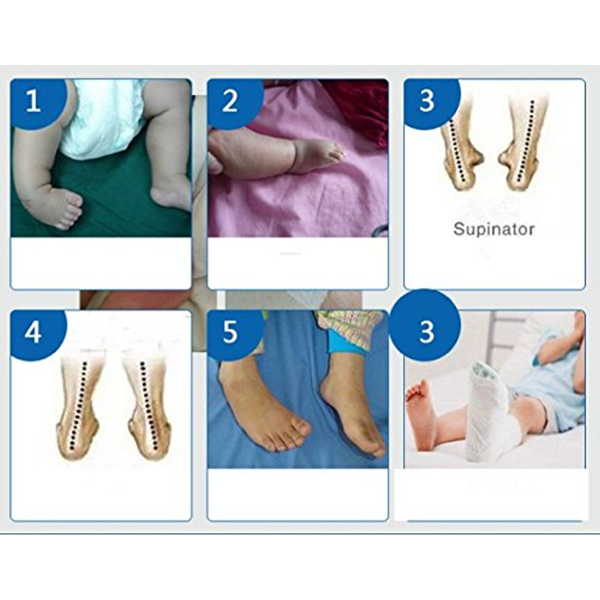 Medical Ankle Splint Boot Brace Support Tendinitis Plantar Fasciitis Heel Foot Splint For Child Kids